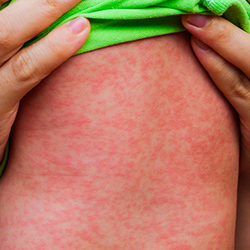 Com sintomas parecidos, dengue e sarampo não devem ser confundidos
